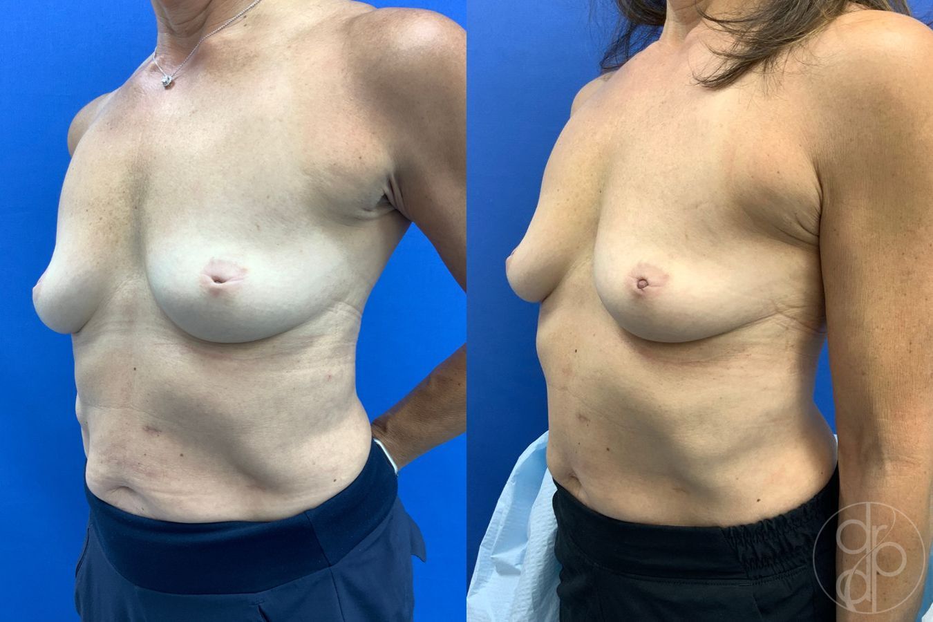 Before and after Inverted Nipple Repair case 43463 - Angle 3