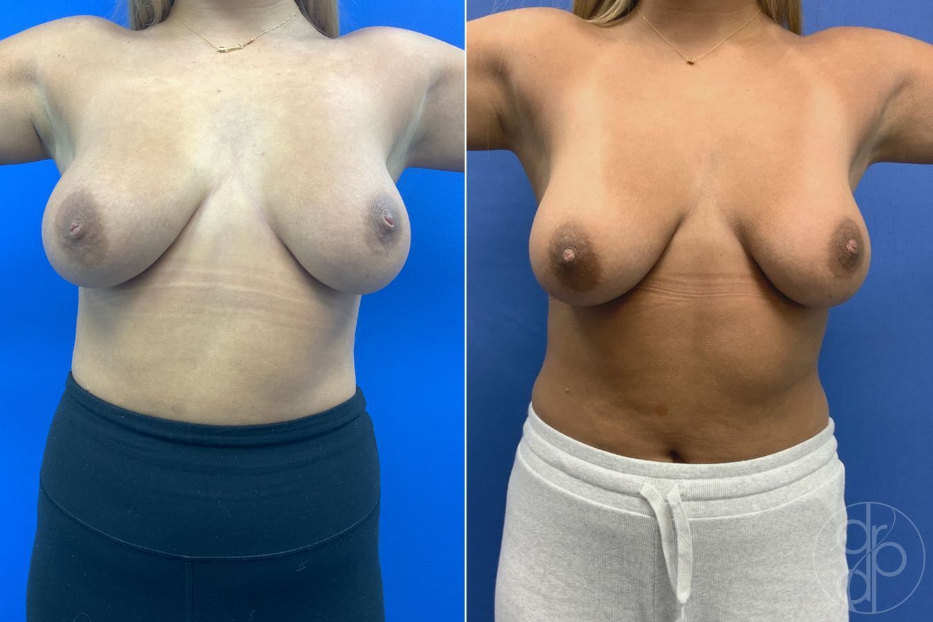 Before and after Inverted Nipple Repair case 43178 - Angle 2