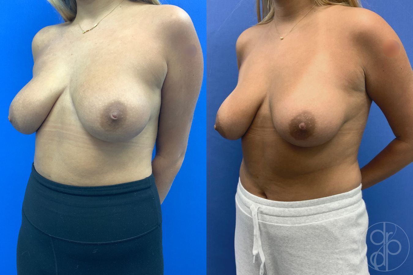 Before and after Inverted Nipple Repair case 43178 - Angle 3