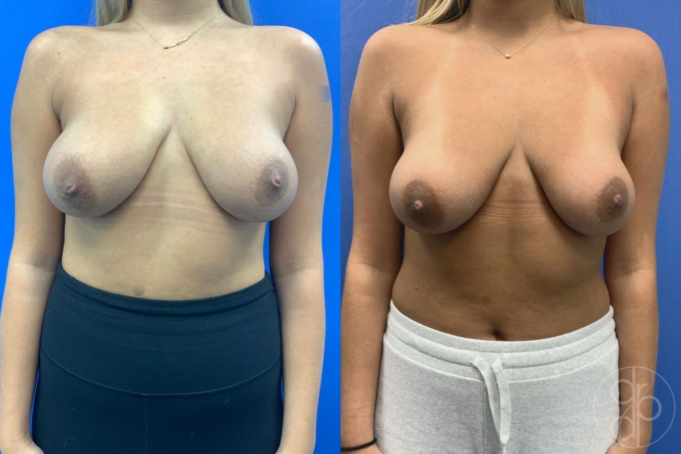 Before and after Inverted Nipple Repair case 43178