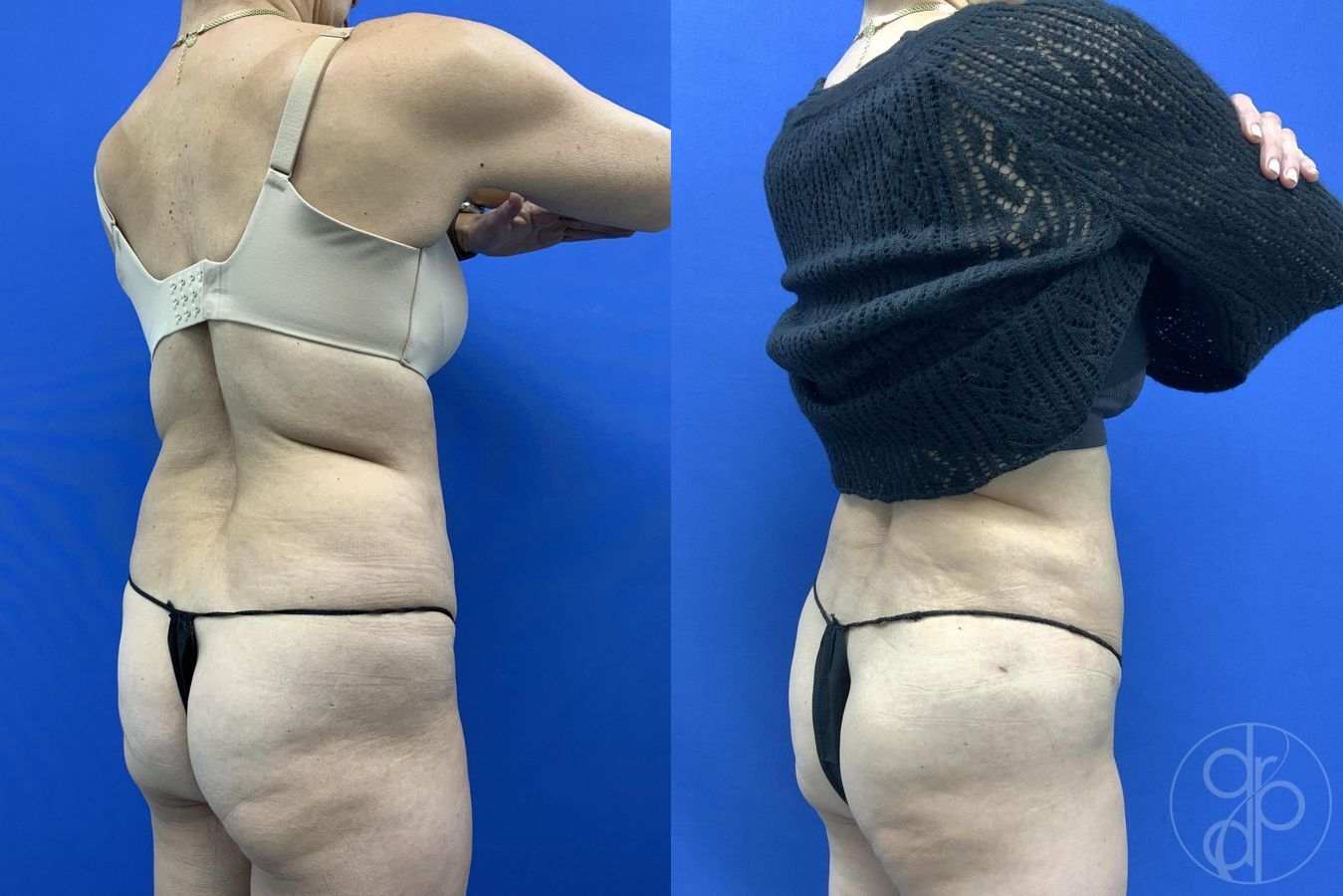 Before and after Liposuction case 29659 - Angle 2