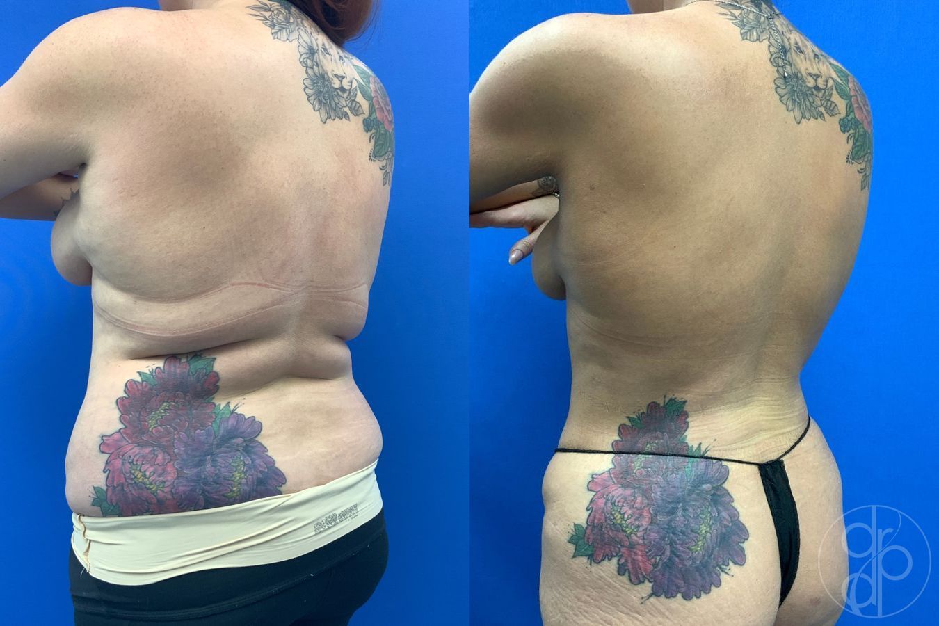 Before and after Liposuction case 43460 - Angle 3