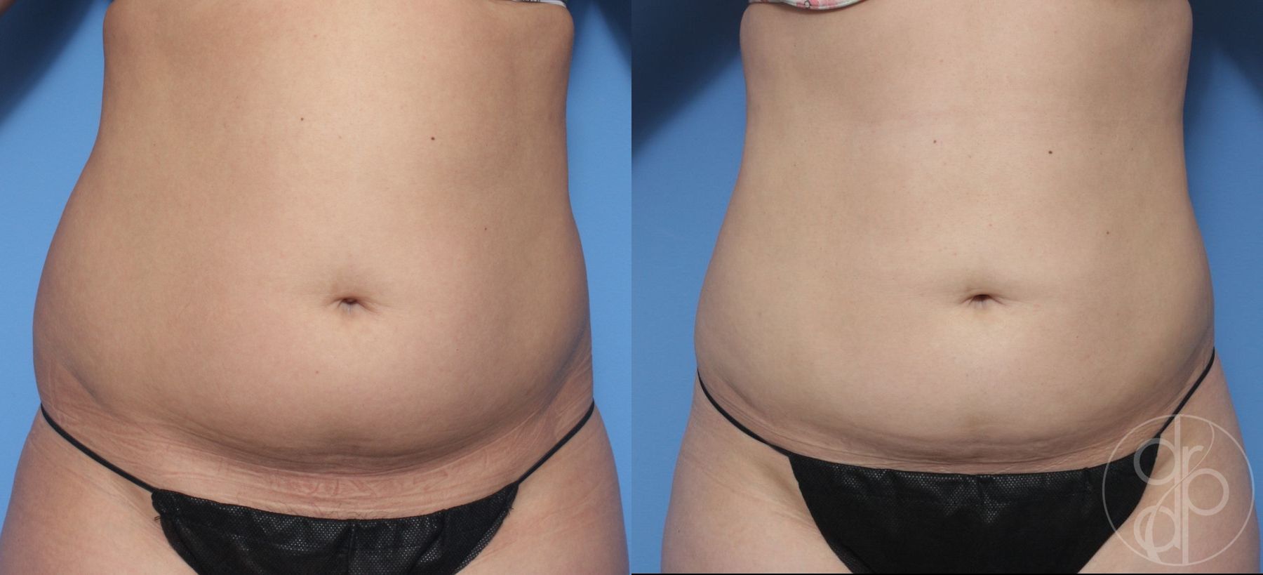 Liposuction - Case 323