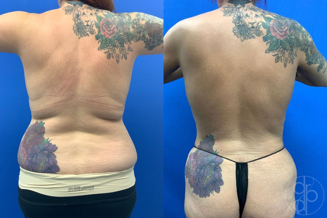 Before and after Liposuction case 43460 - Angle 2