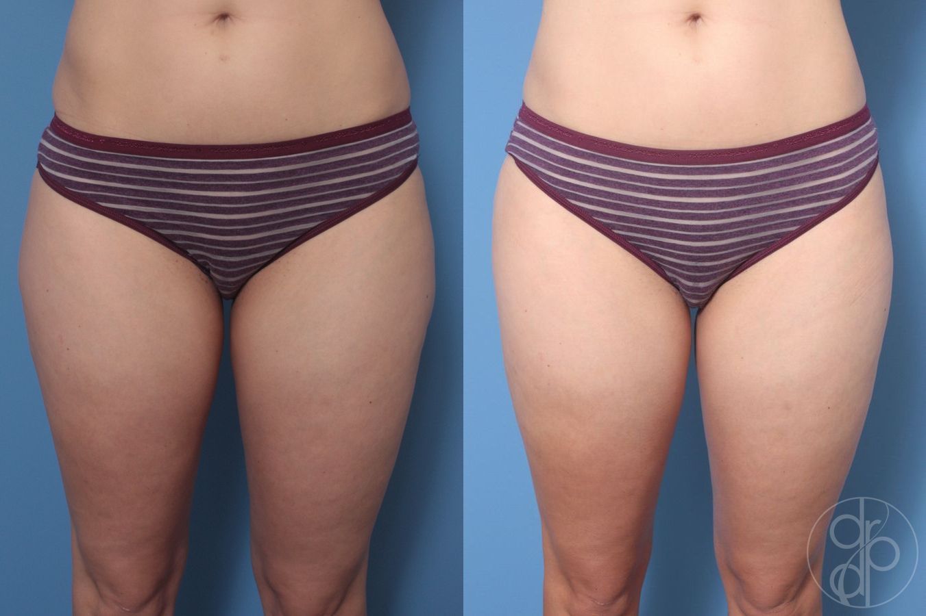 Before and after Liposuction case 29872