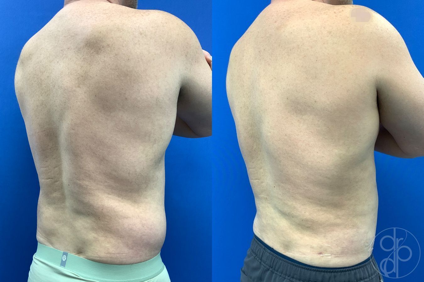 Before and after Liposuction case 41721 - Angle 4