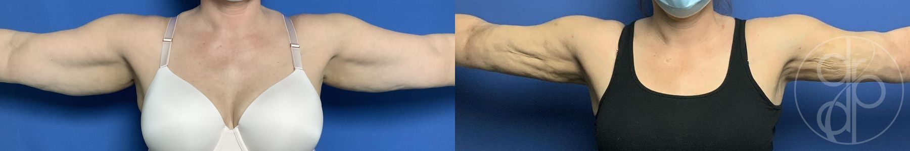 Liposuction - Case 312