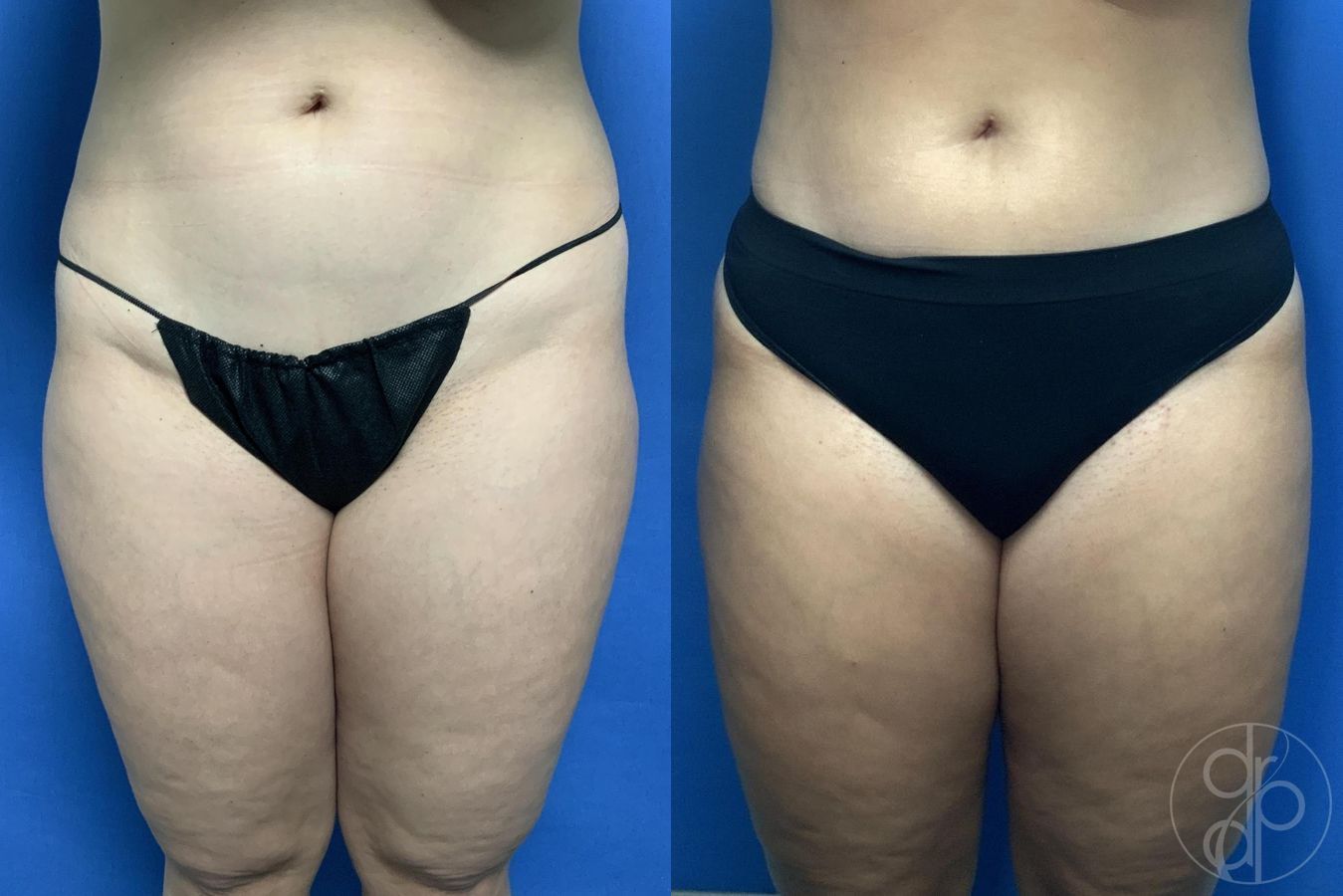 Liposuction - Case 319