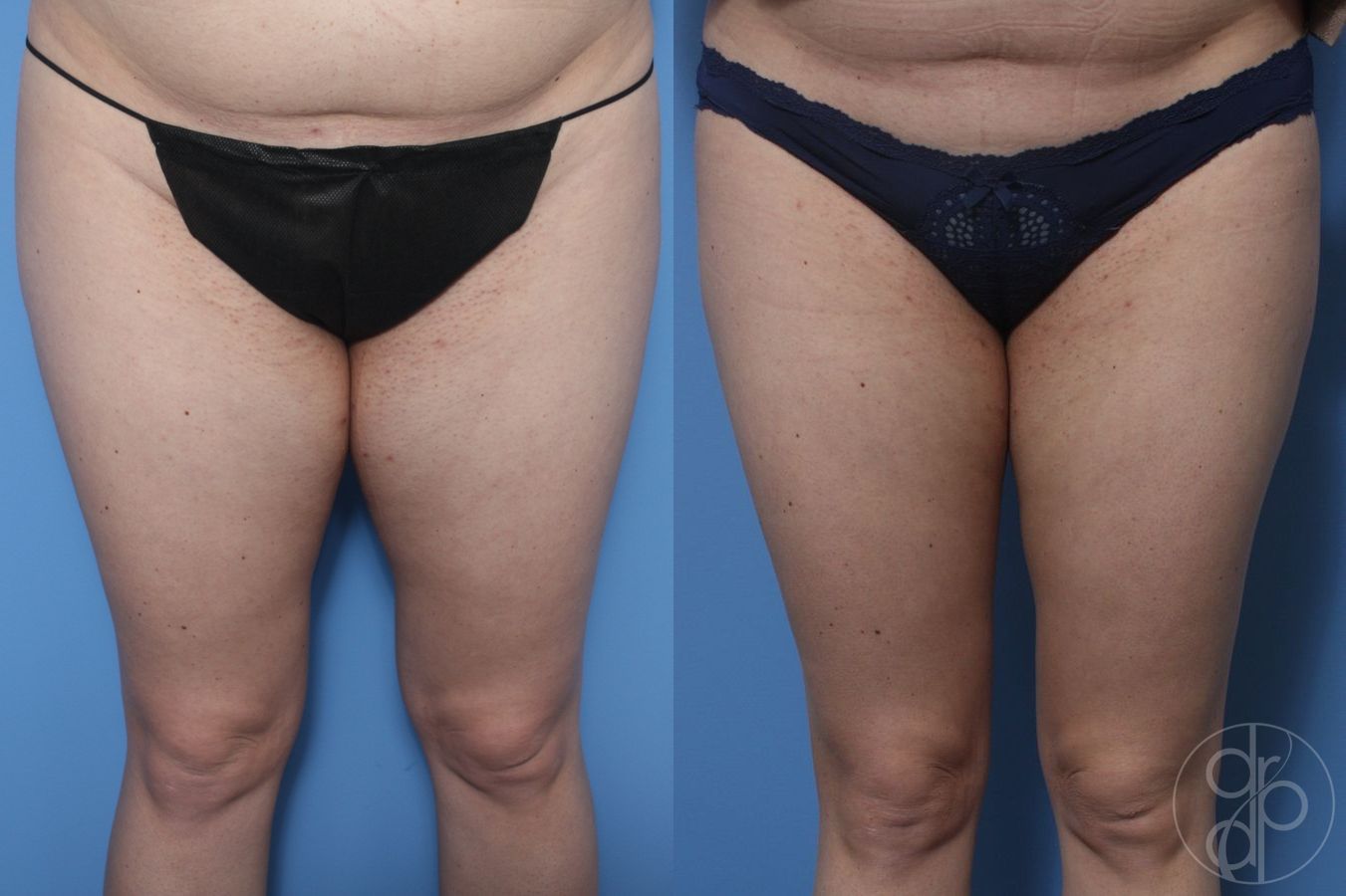 Before and after Liposuction case 29781