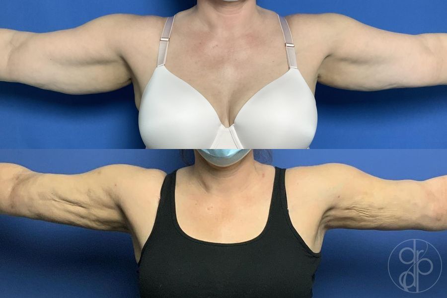 Before and after Liposuction case 29582