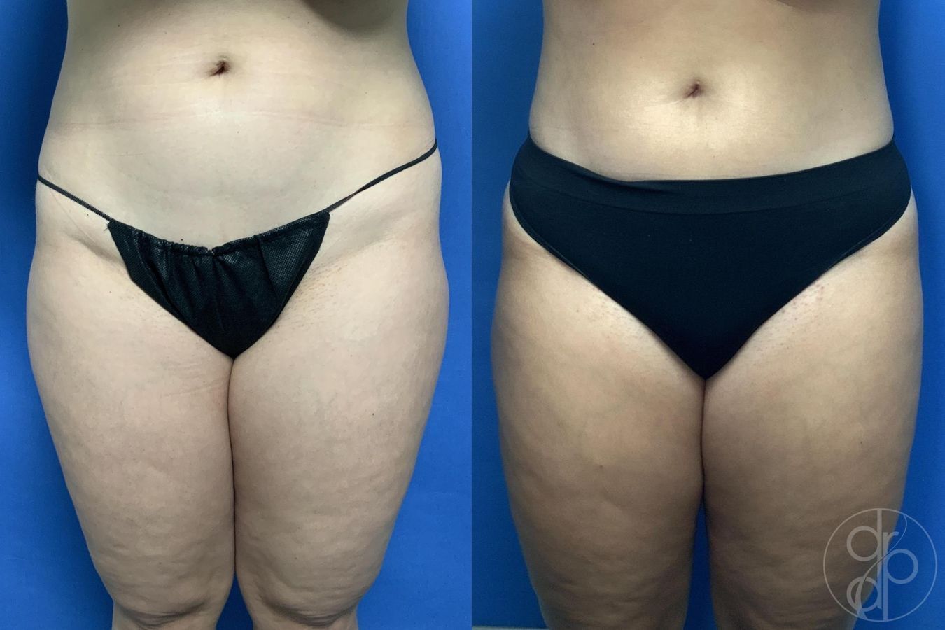 Before and after Liposuction case 29971