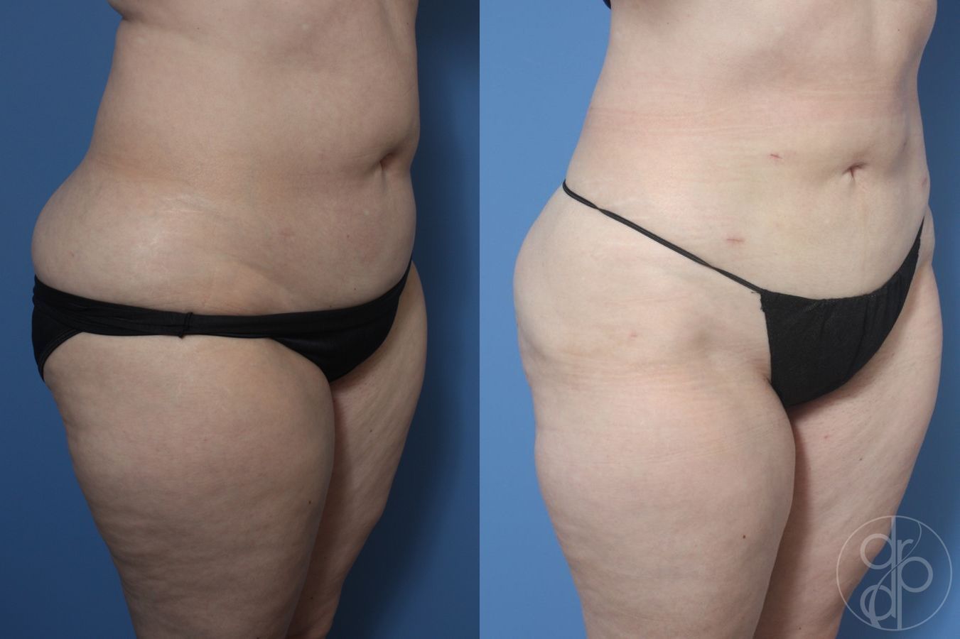 Before and after Liposuction case 29882 - Angle 4