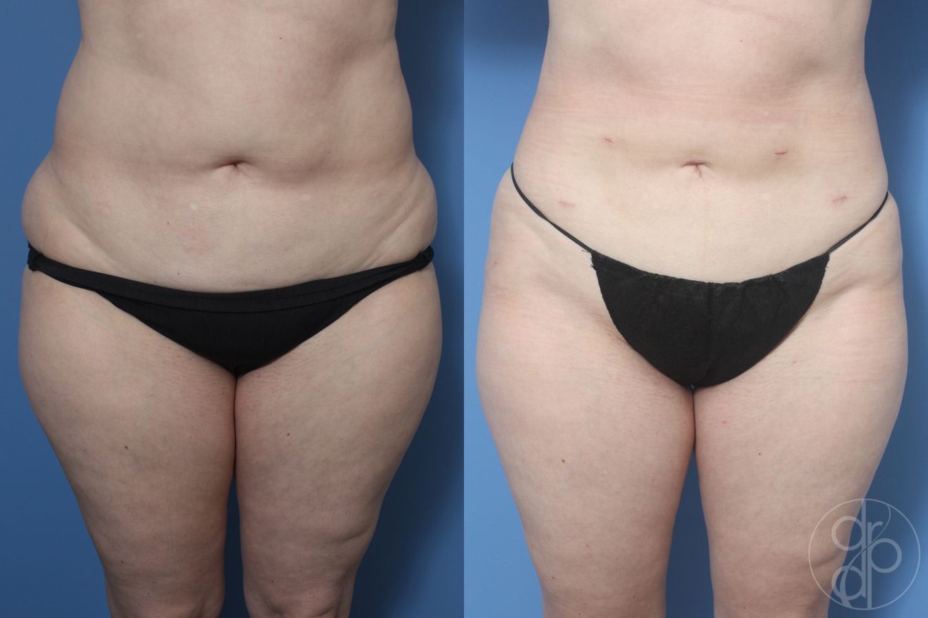 Before and after Liposuction case 29882
