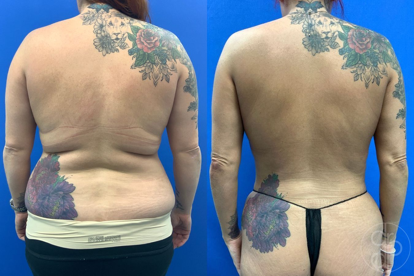 Before and after Liposuction case 43460
