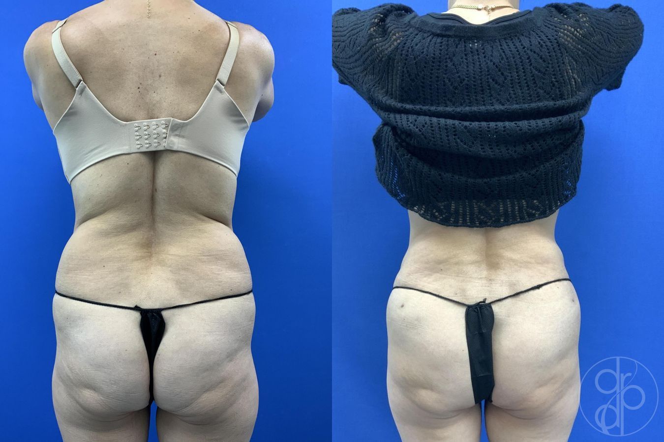 Before and after Liposuction case 29659
