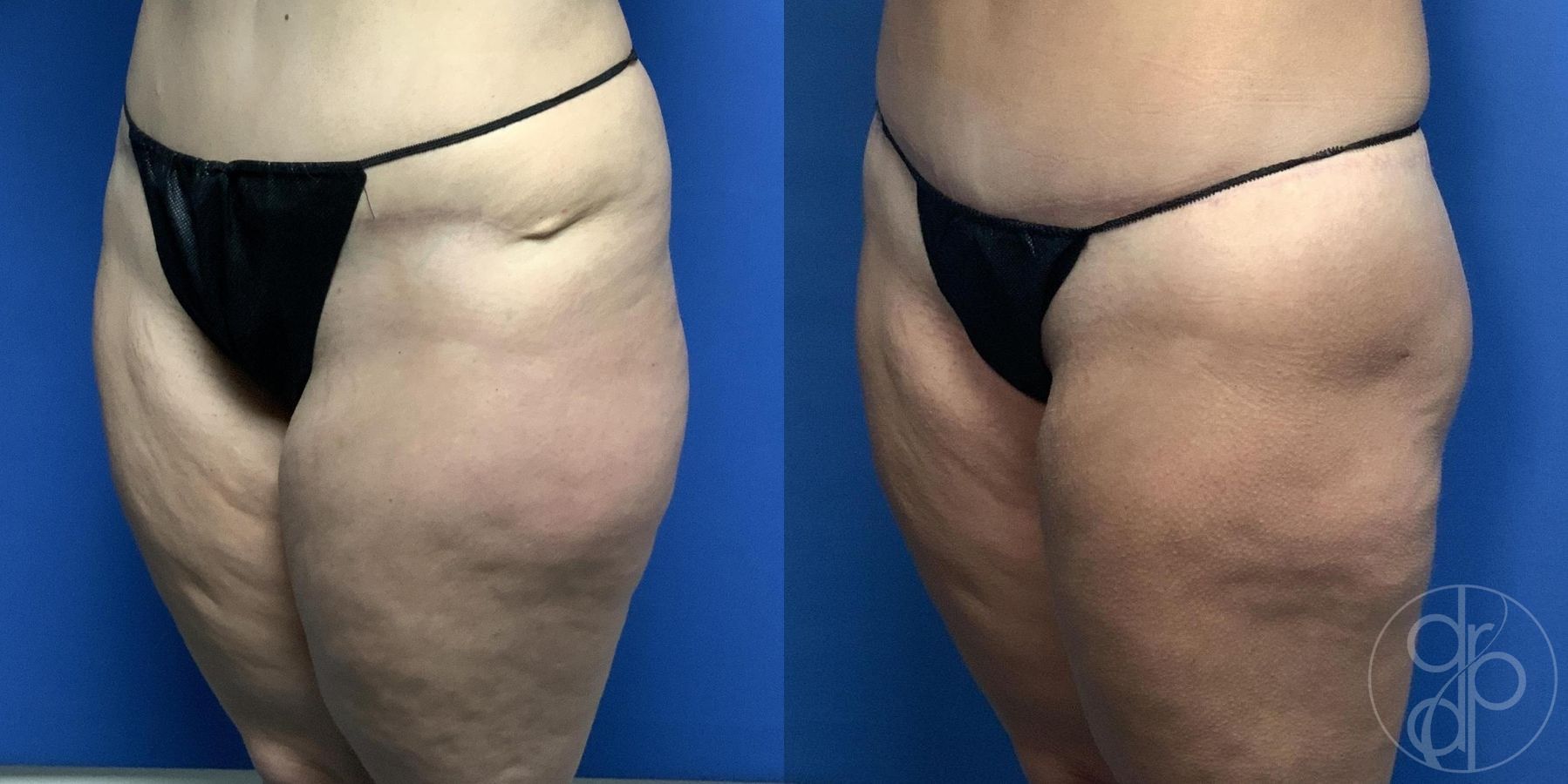 Before and after Liposuction case 29975 - Angle 2