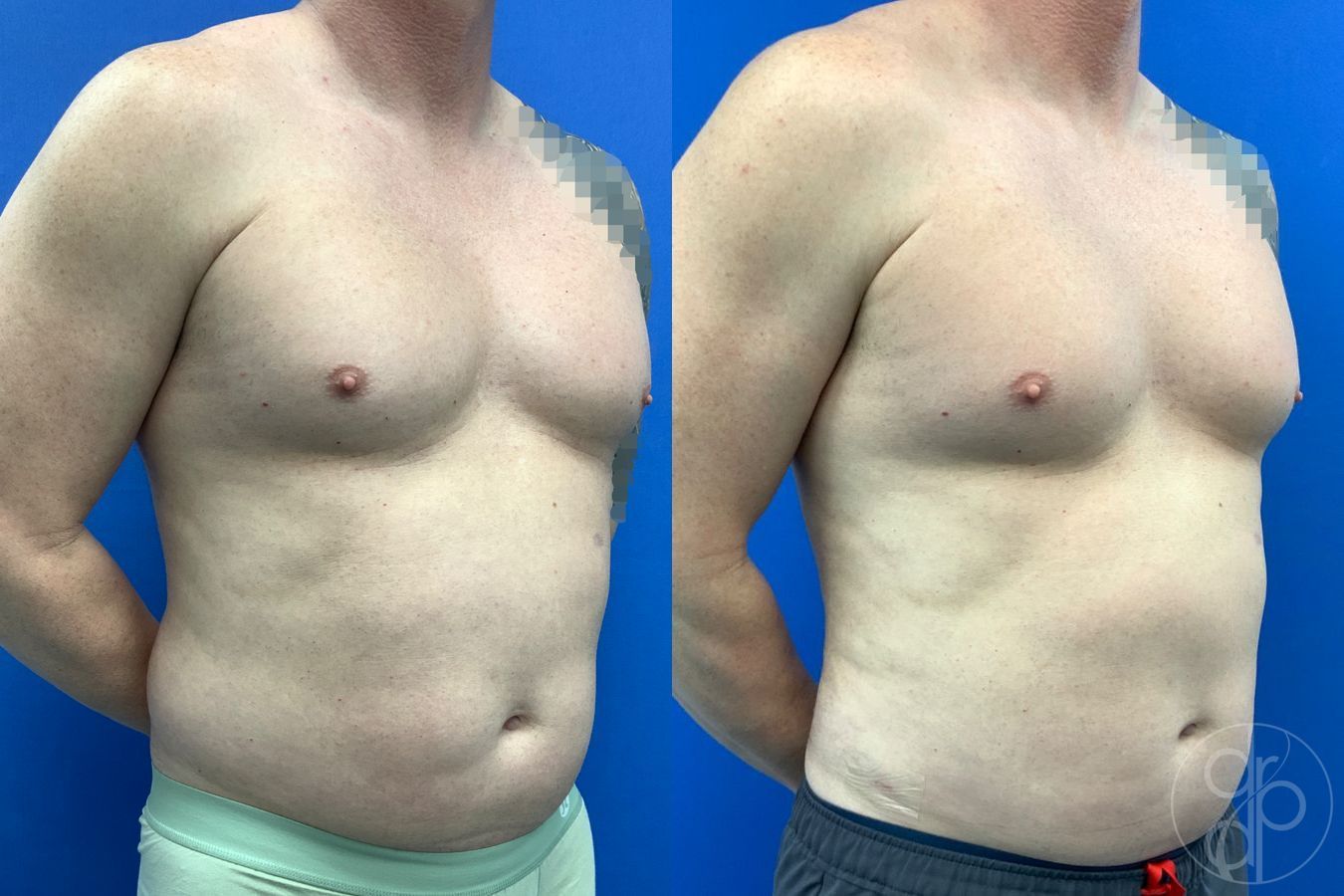 Before and after Liposuction case 41721 - Angle 2