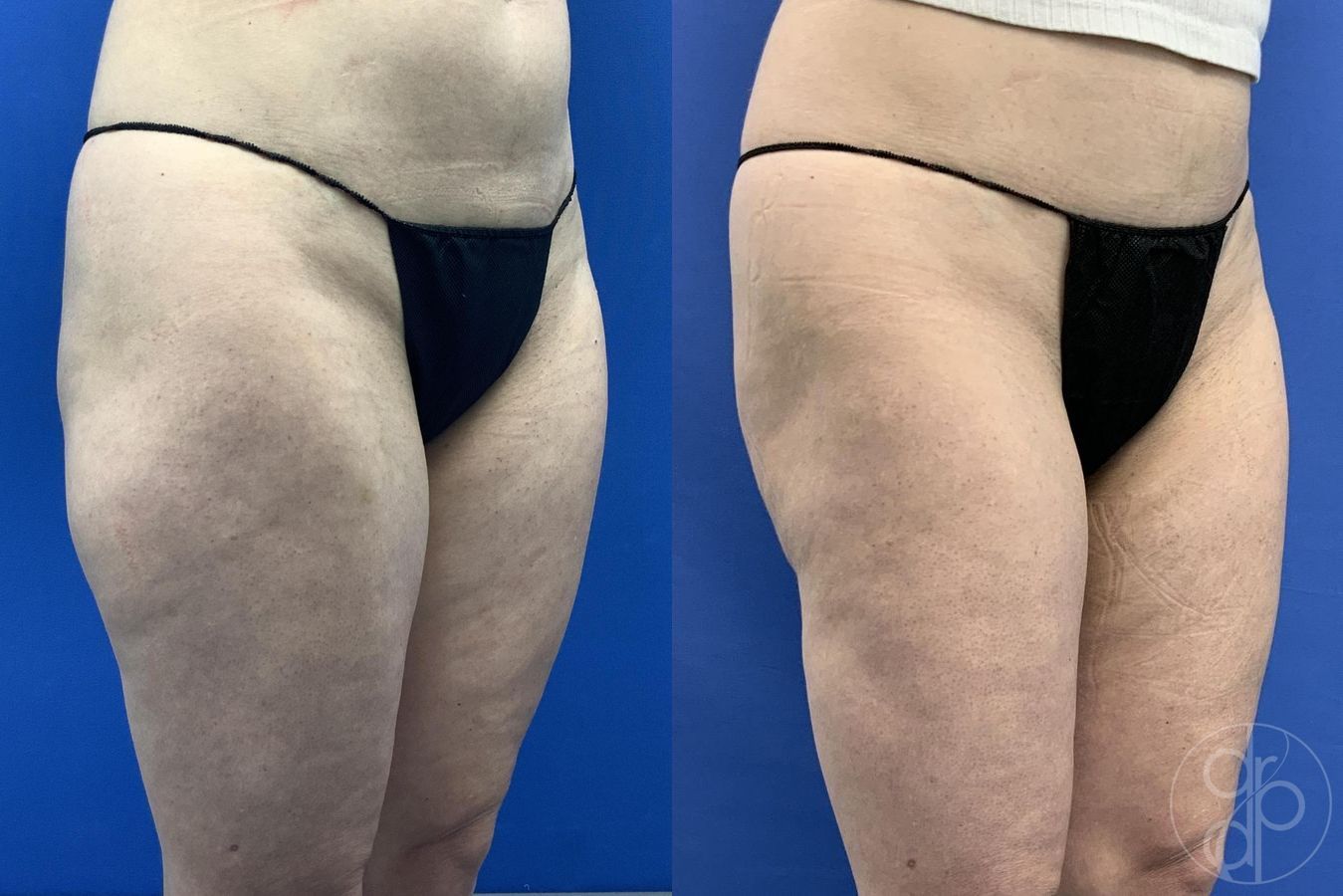 Before and after Liposuction case 30021 - Angle 8