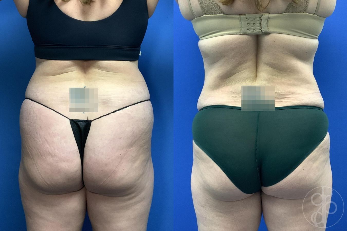 Before and after Liposuction case 30000