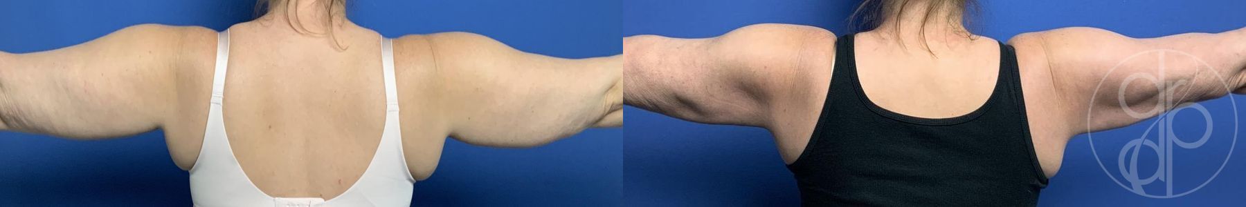 Liposuction - Thumbnail 2