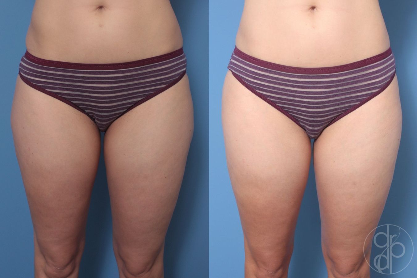 Liposuction - Case 324