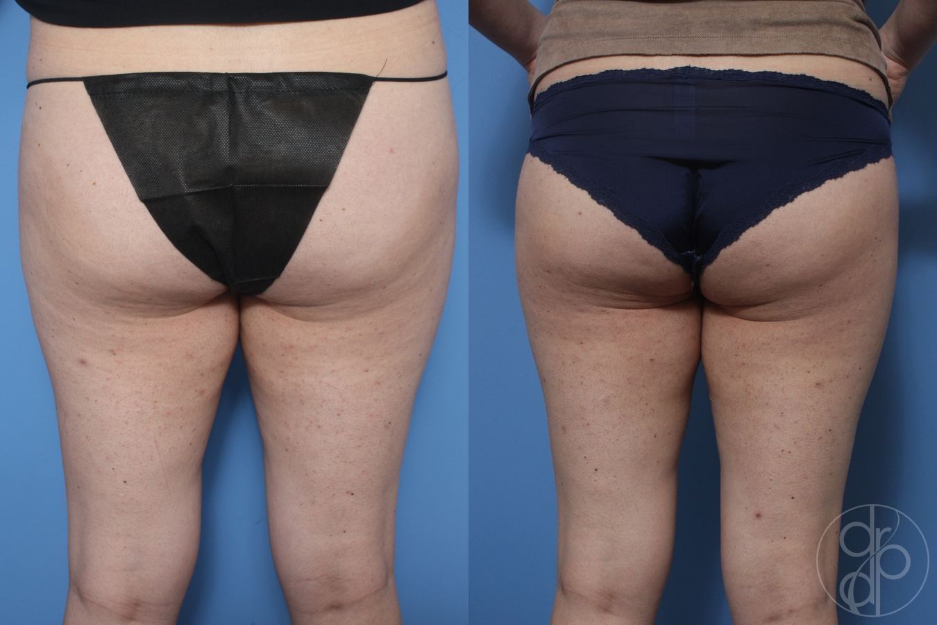 Before and after Liposuction case 29781 - Angle 2