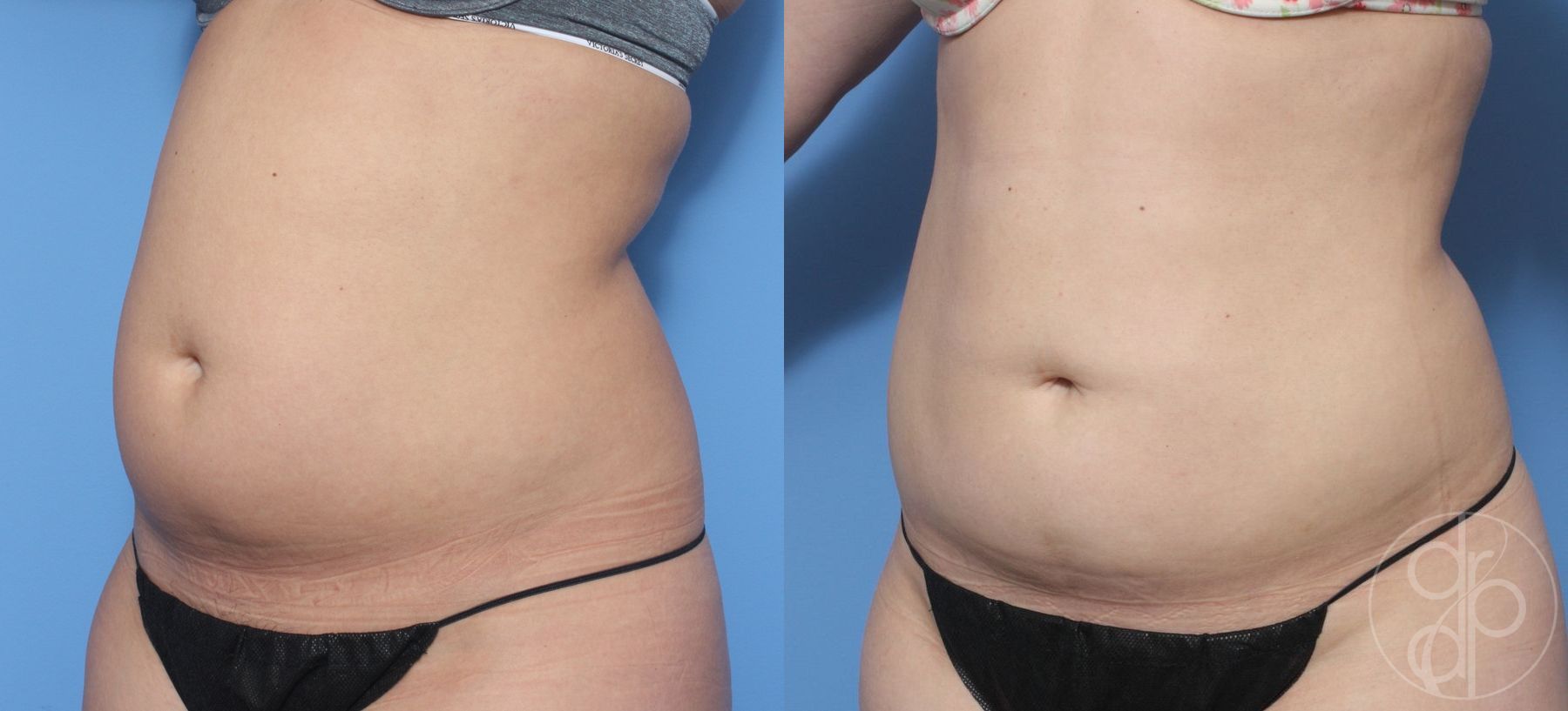 Liposuction - Thumbnail 2