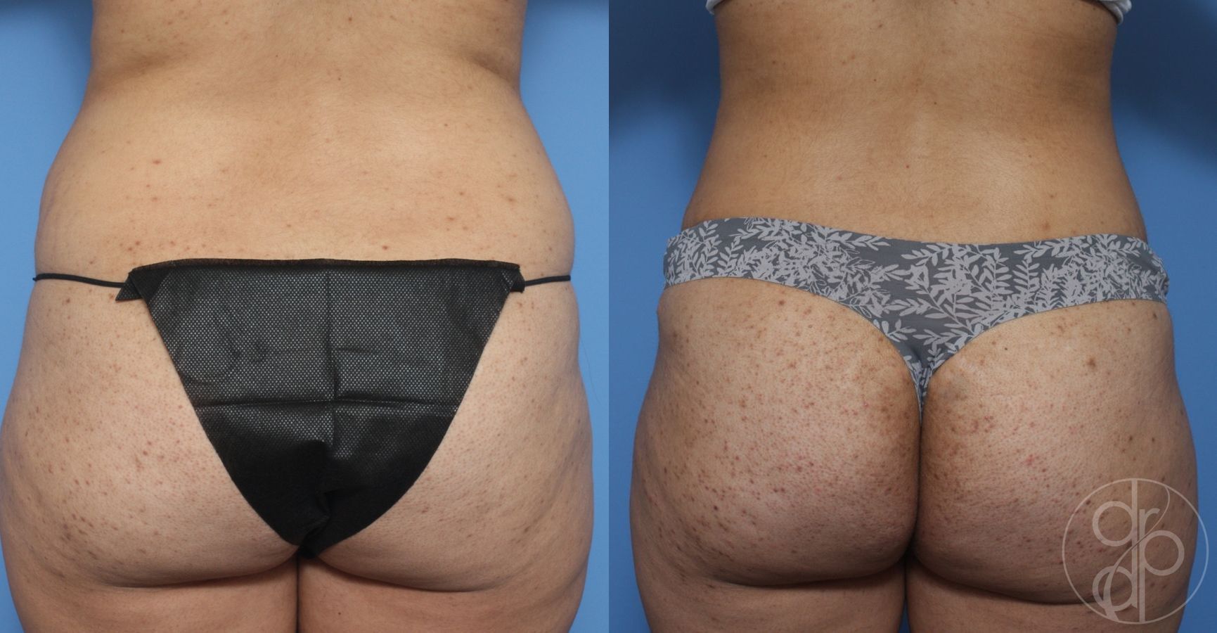 Liposuction - Case 321