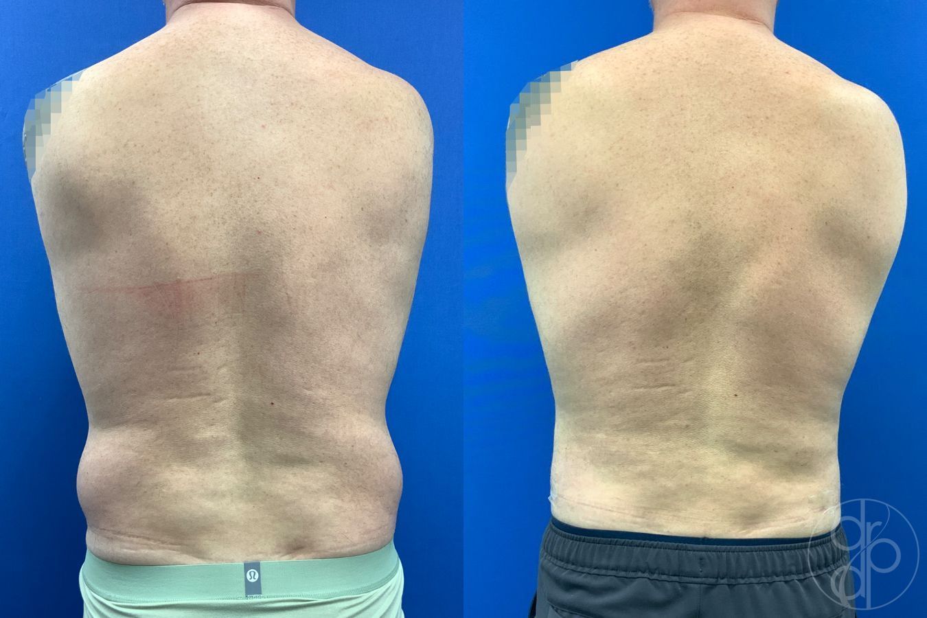 Before and after Liposuction case 41721 - Angle 5