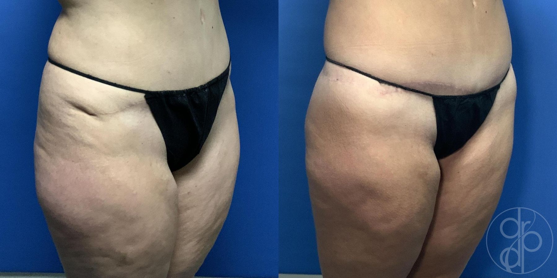 Before and after Liposuction case 29975 - Angle 3