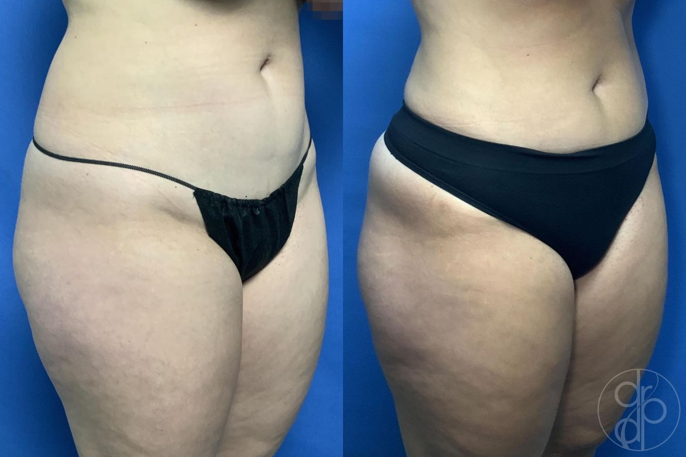 Before and after Liposuction case 29971 - Angle 3