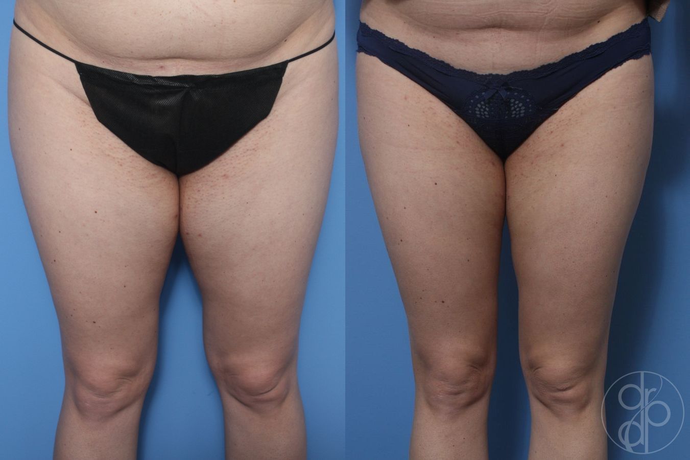 Before and after Liposuction case 29781