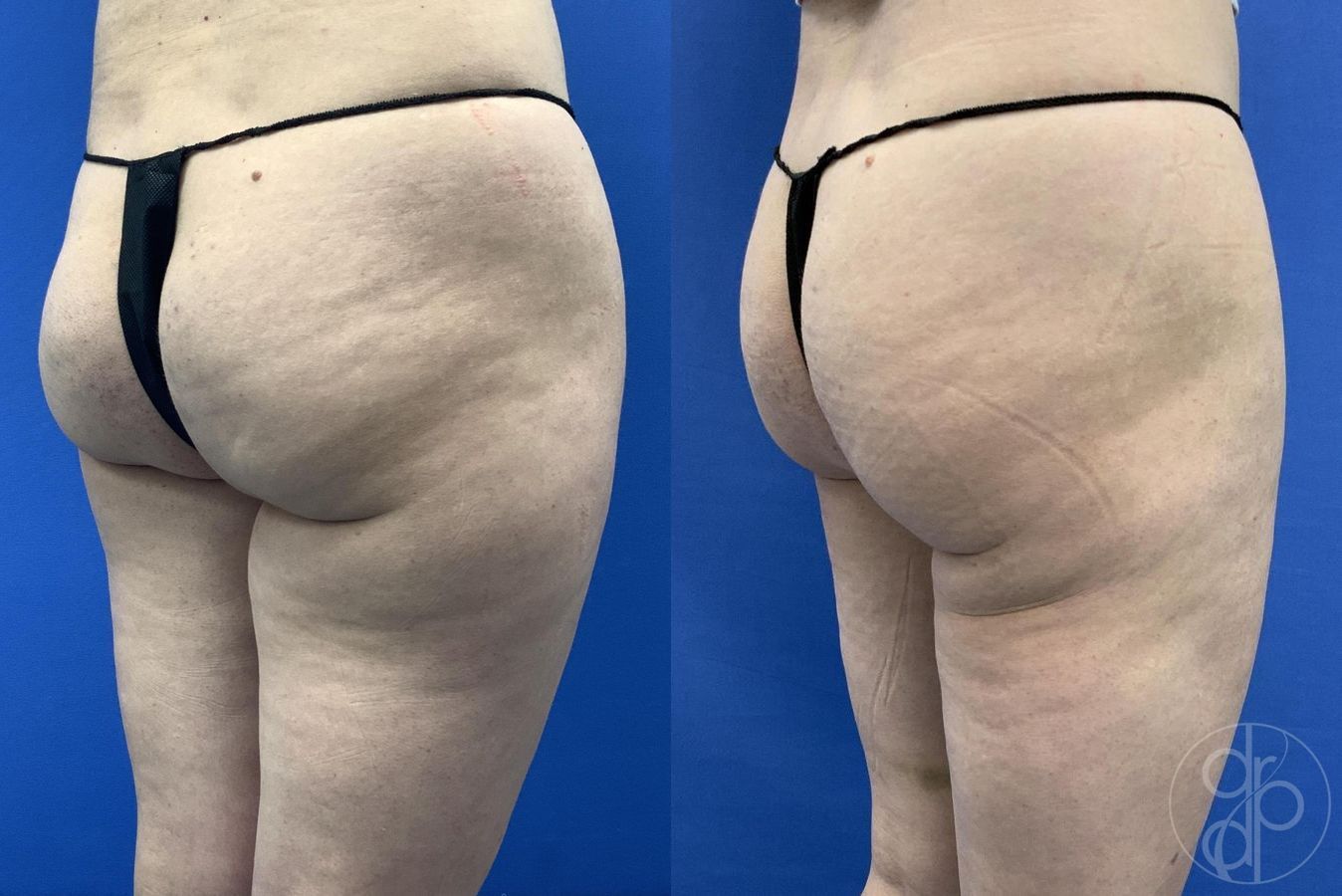 Before and after Liposuction case 30021 - Angle 6