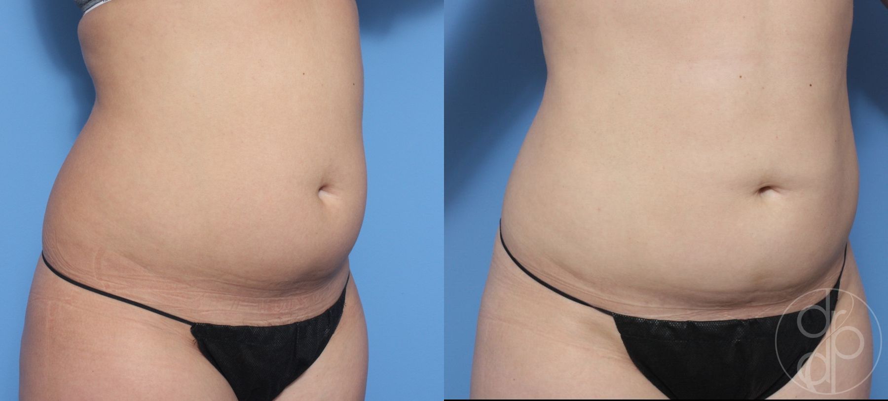 Liposuction - Thumbnail 3