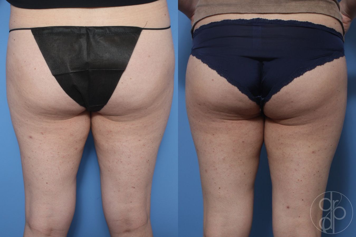 Before and after Liposuction case 29781 - Angle 2
