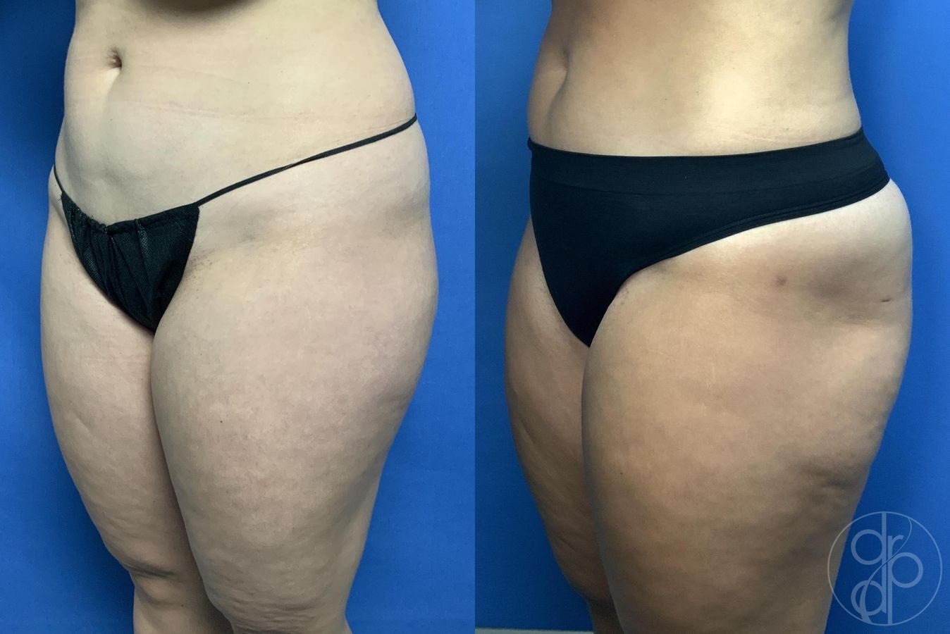Before and after Liposuction case 29971 - Angle 4