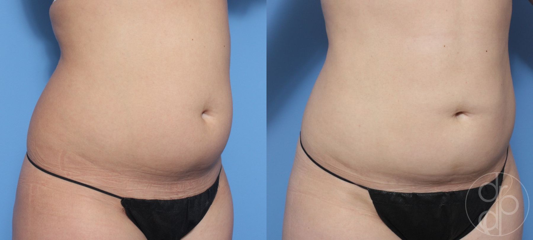 Before and after Liposuction case 29874 - Angle 3