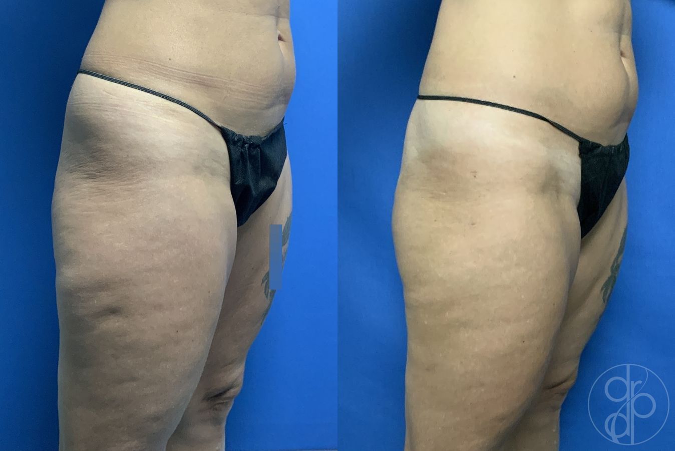 Before and after Liposuction case 29898 - Angle 2