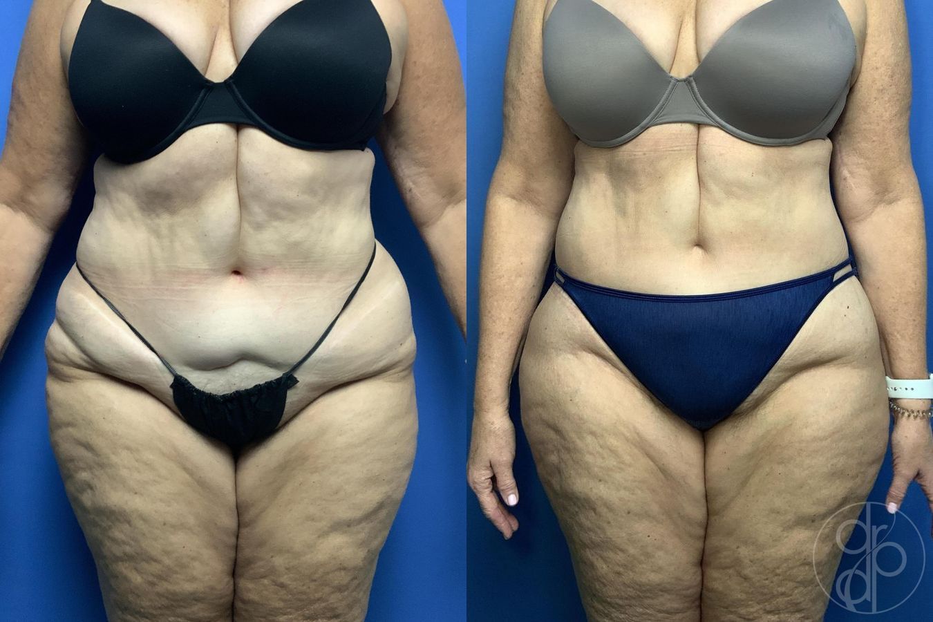 Before and after Liposuction case 30019