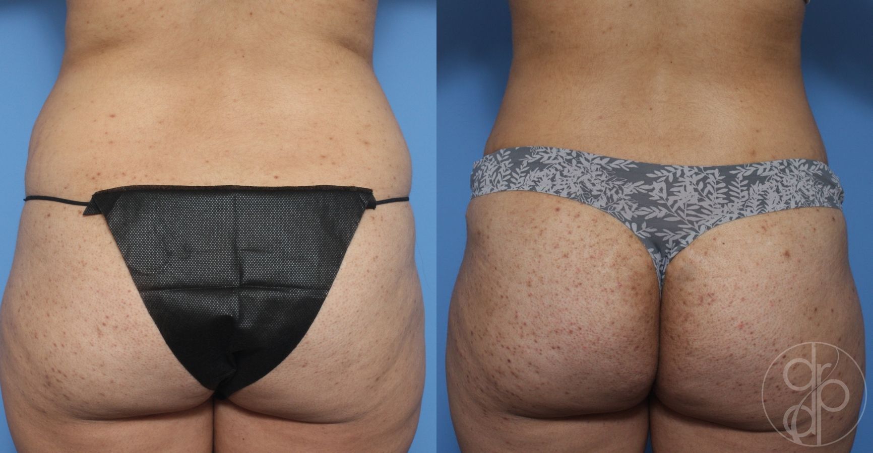 Before and after Liposuction case 29864