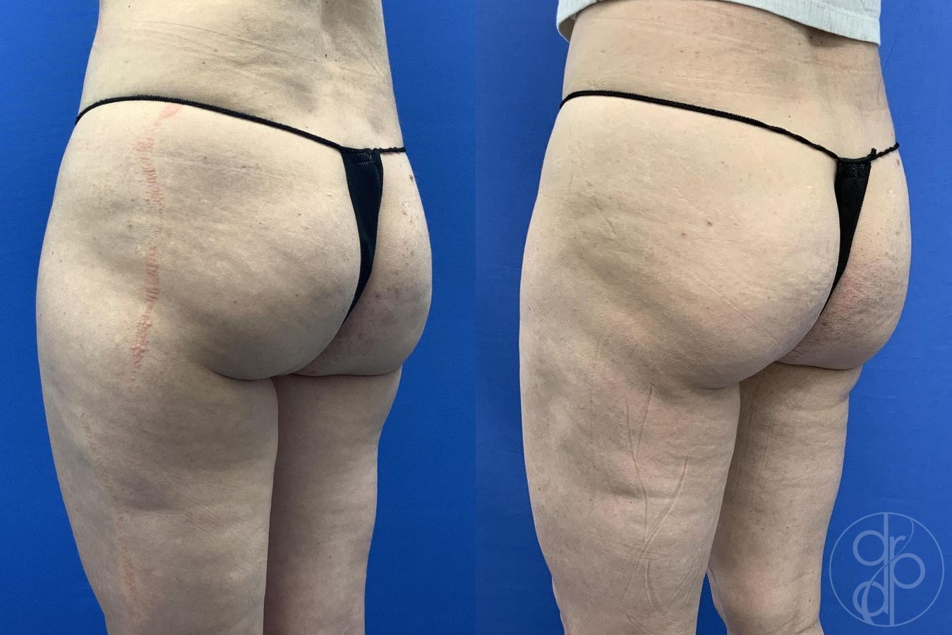 Before and after Liposuction case 30021 - Angle 4