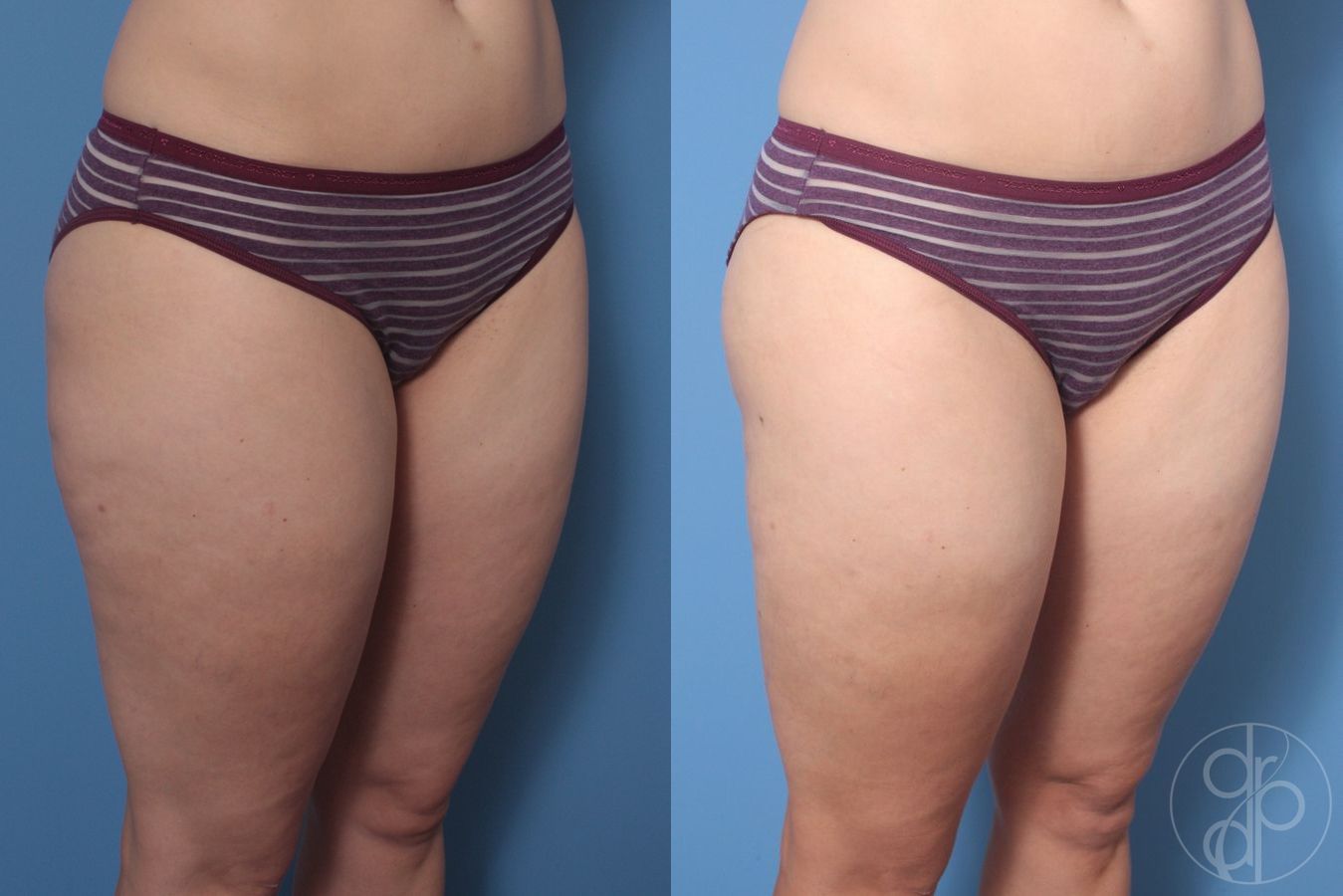 Before and after Liposuction case 29872 - Angle 3