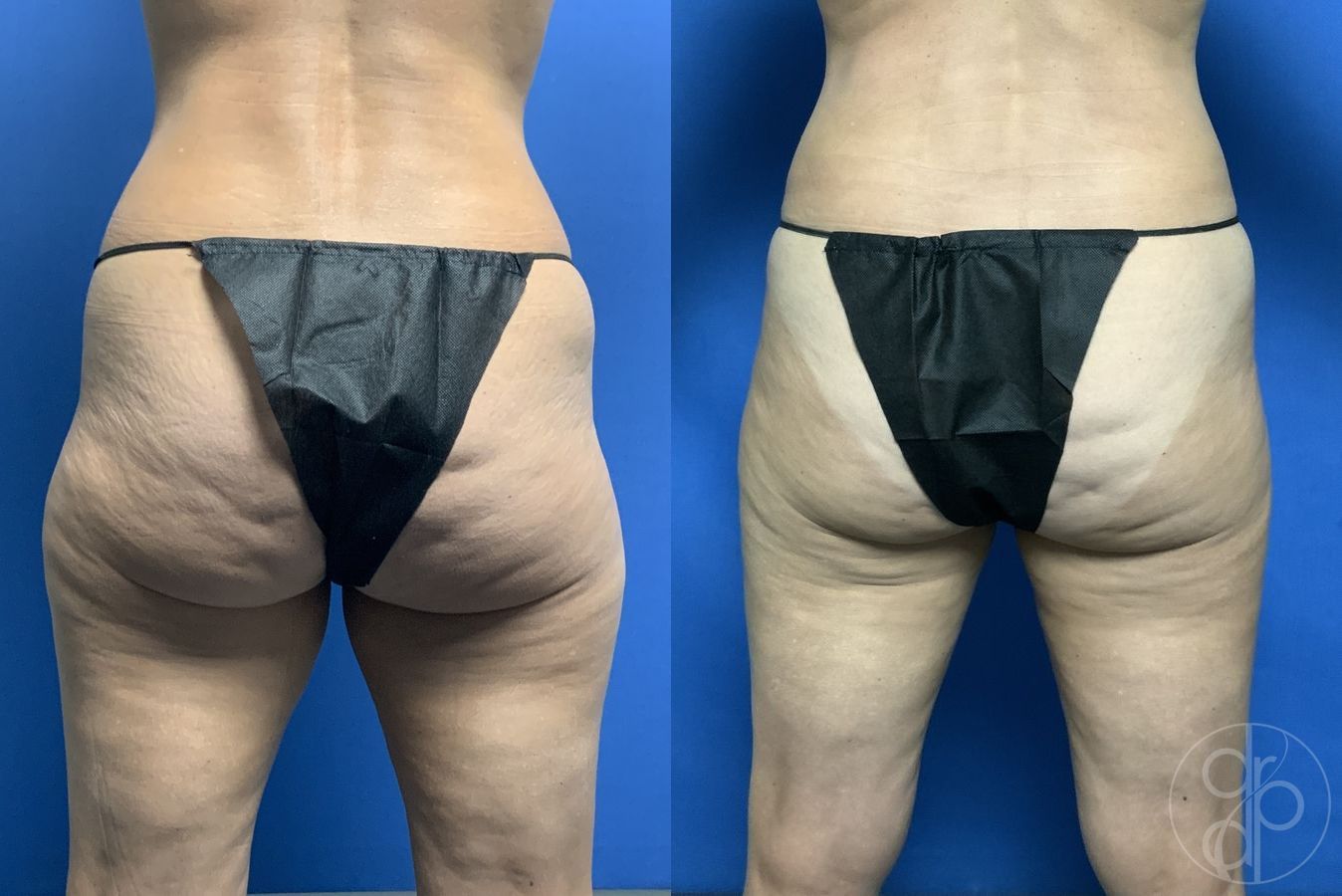 Before and after Liposuction case 29898 - Angle 3