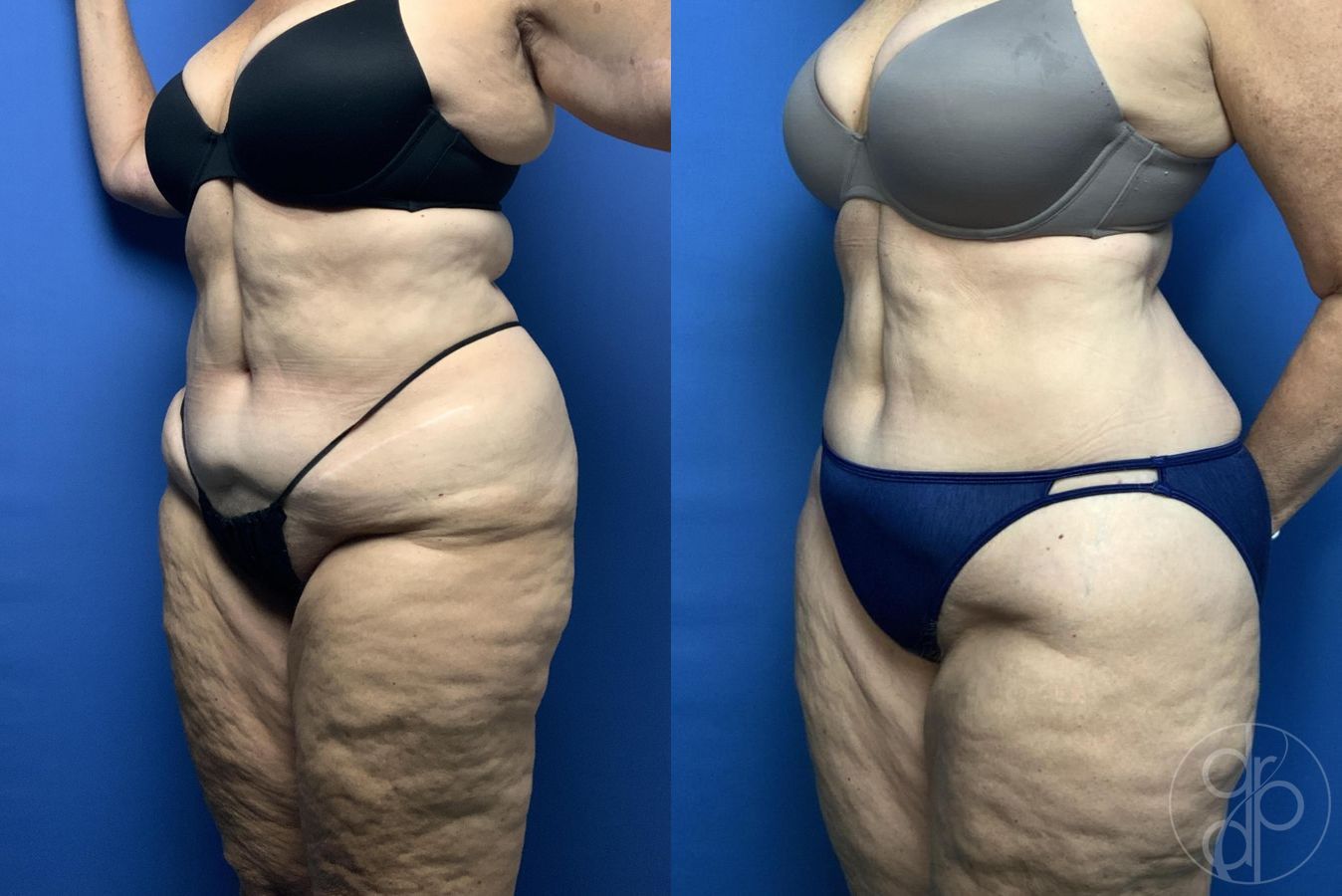 Before and after Liposuction case 30019 - Angle 3