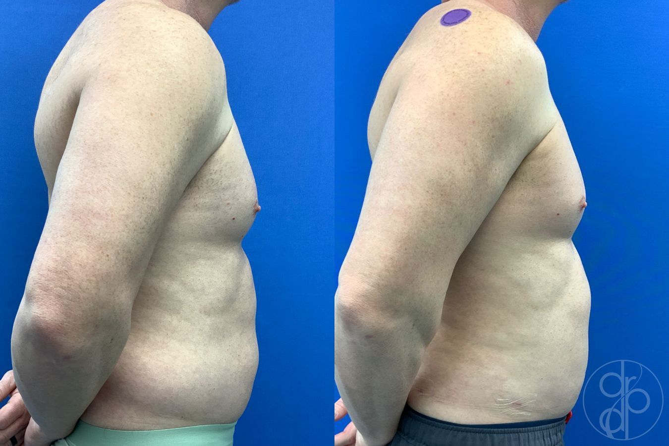 Before and after Liposuction case 41721 - Angle 3