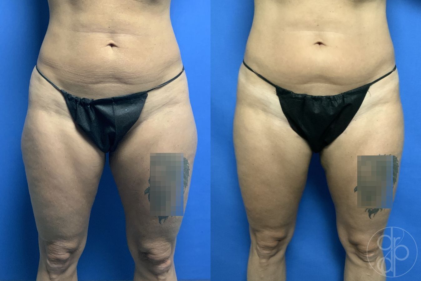 Before and after Liposuction case 29898
