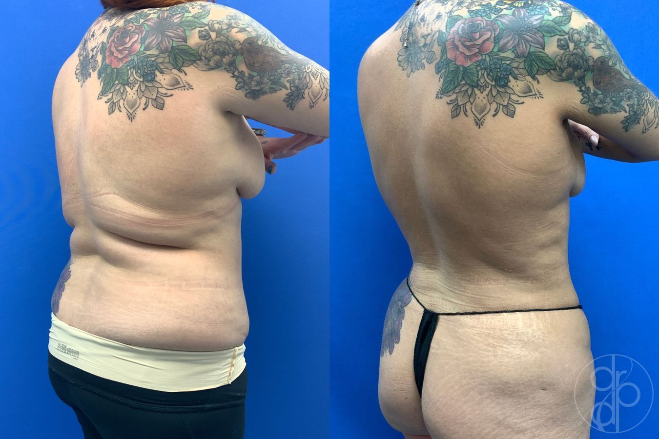 Before and after Liposuction case 43460 - Angle 4
