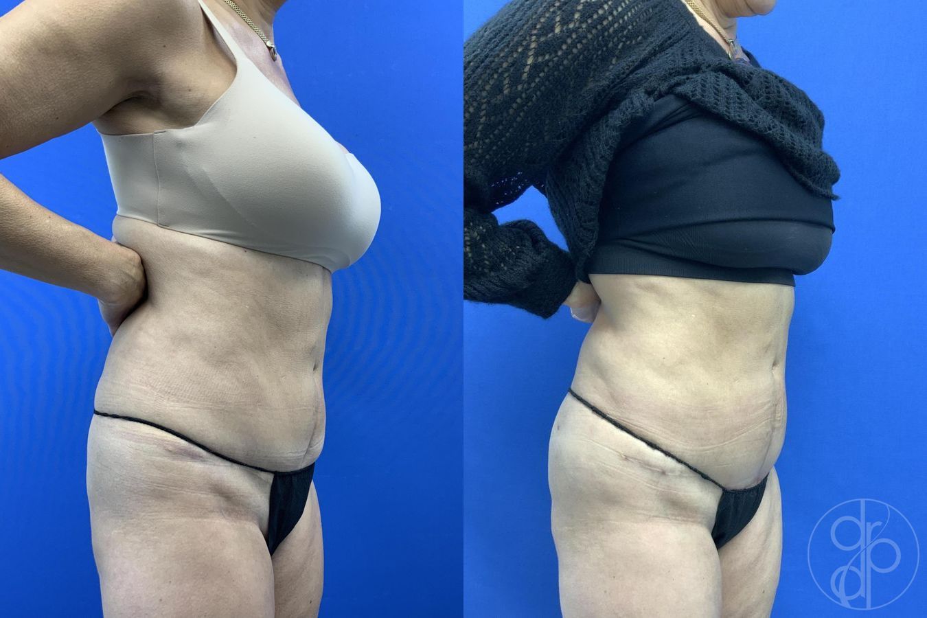 Before and after Liposuction case 29659 - Angle 5