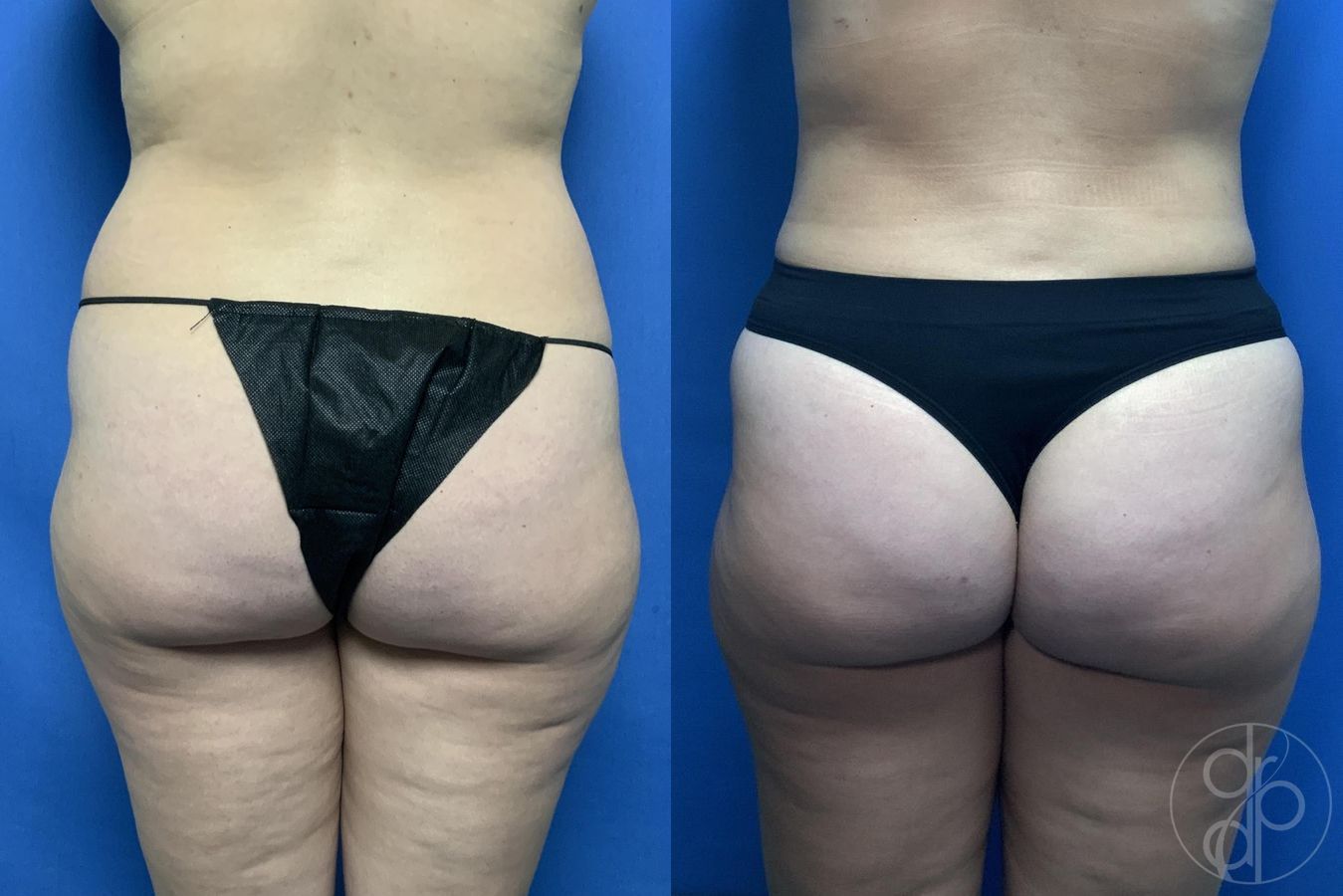 Before and after Liposuction case 29971 - Angle 2