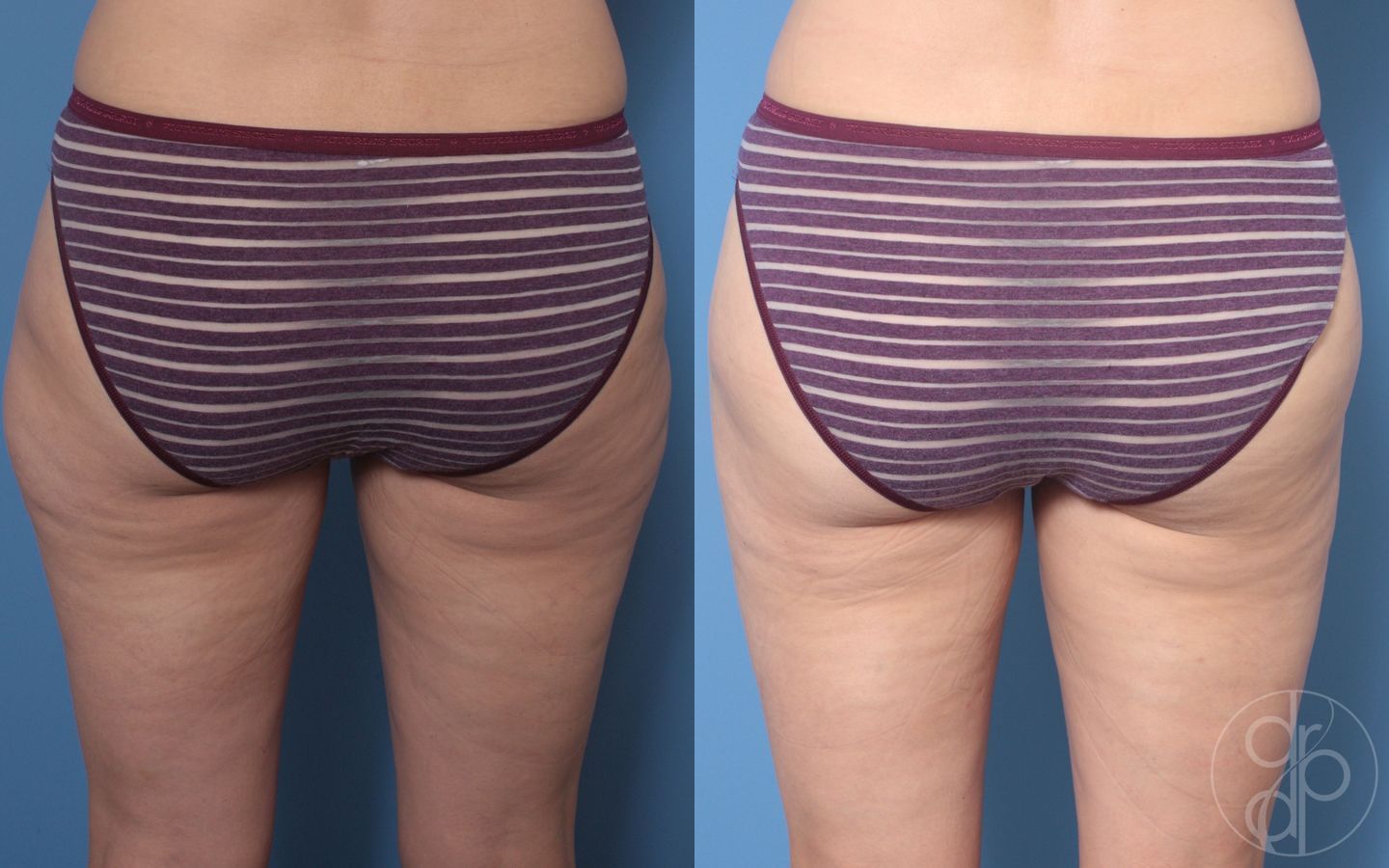 Before and after Liposuction case 29872 - Angle 4